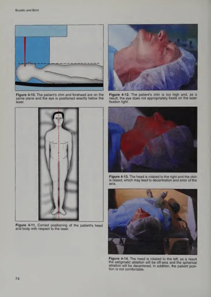 Что будет, если пошевелить глазом во время лазерной коррекции зрения?