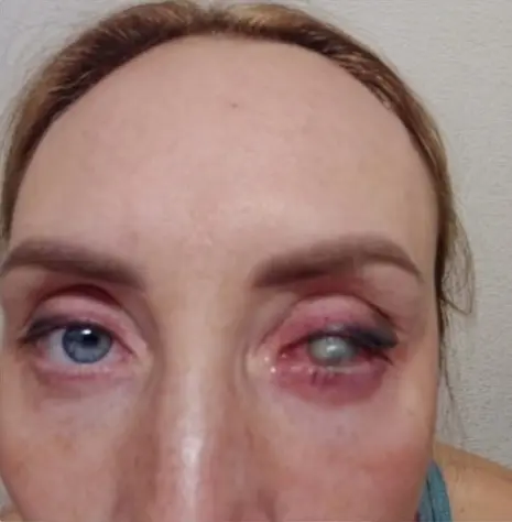 Девушке из Оренбурга удалили глаз после лазерной коррекции зрения