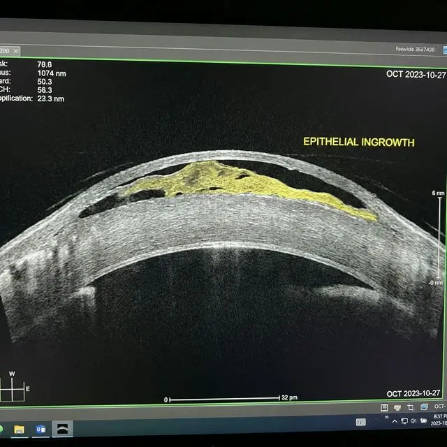 ОКТ-сканирование роговицы (поперечный срез) при врастании эпителия. Гиперрефлективный слой клеток приподнимает лоскут.