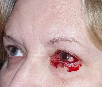 Кровоизлияние в глаз после LASIK