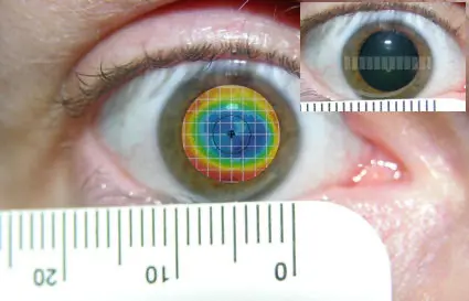 Лазерная коррекция и большие зрачки: история болезни 2