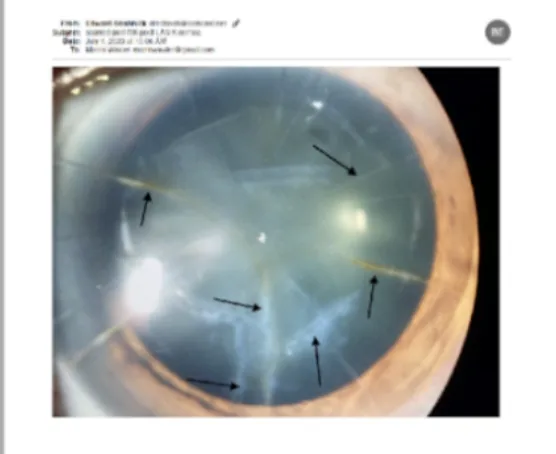 Рубцевание роговицы после радиальной кератотомии с последующим LASIK
