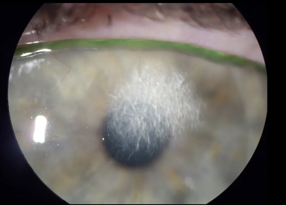 Кристаллическая кератопатия: белые кристаллы в центре роговицы после LASIK
