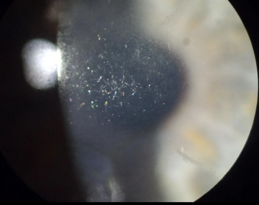 Врастание эпителия после двух операций РК и LASIK