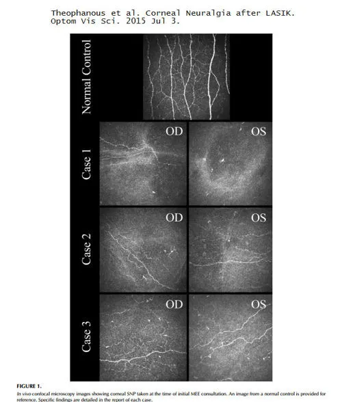 Нервы роговицы под микроскопом