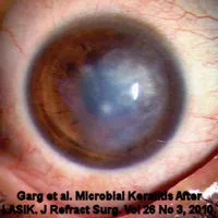 Инфекционный кератит после LASIK