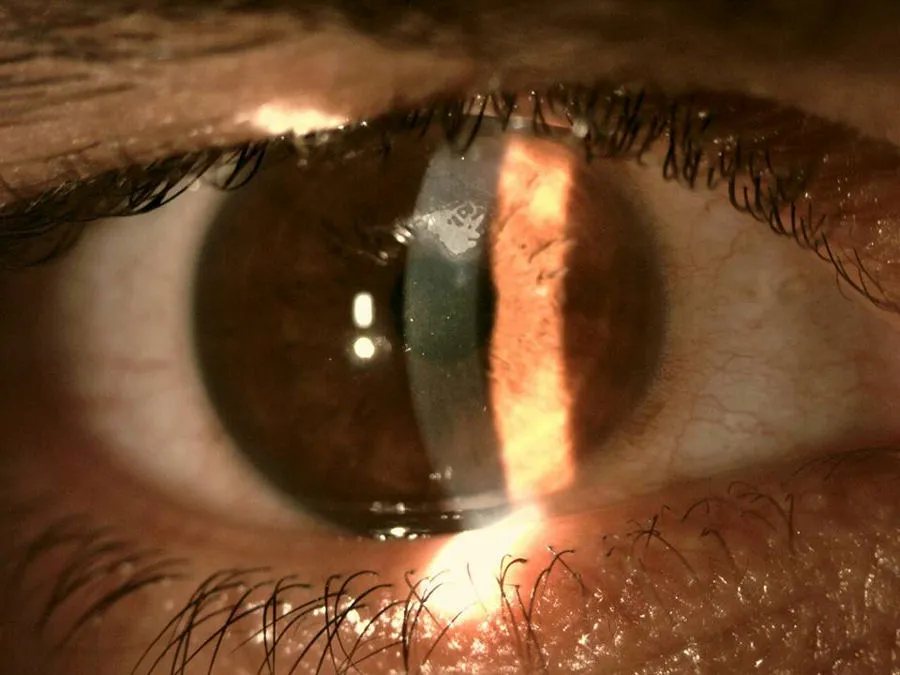 Врастание эпителия после SMILE/LASIK