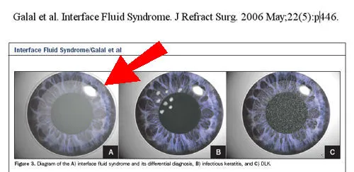 Жидкость в интерфейсе роговицы