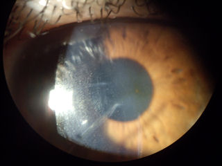 RK incisions into visual axis