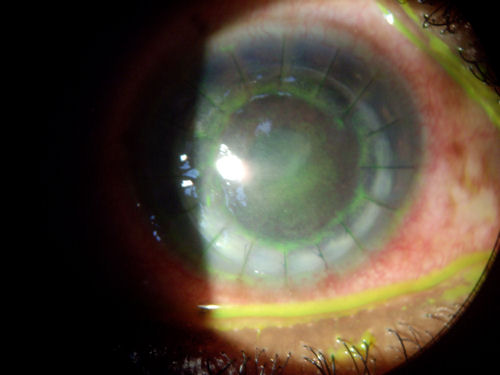 corneal transplant 2 weeks after surgery
