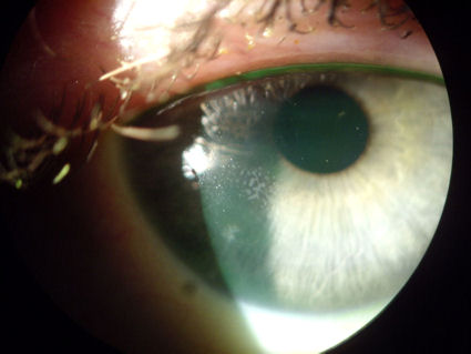 post lasik epithelial ingrowth