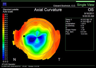 topography of post-RK cornea with ectasia