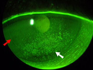 post-LASIK post-PRK dry eye