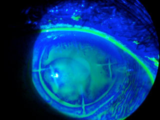 2 RK, LASIK, ectasia