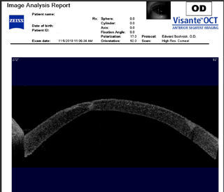 post RK post LASIK ectasia