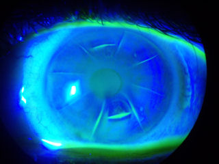 deep horizontal RK incisions