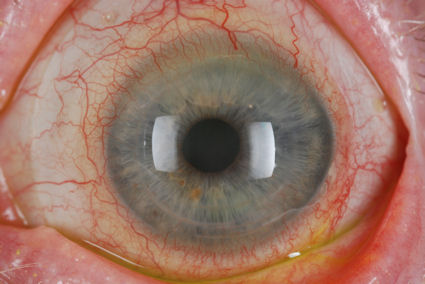 post-LASIK epithelial ingrowth