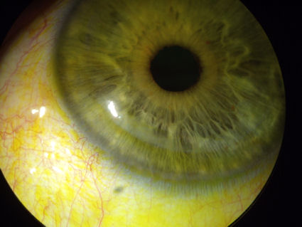 2_yrs_post-LASIK_epi-ingrowth