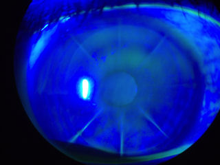 2 RK, LASIK, ectasia