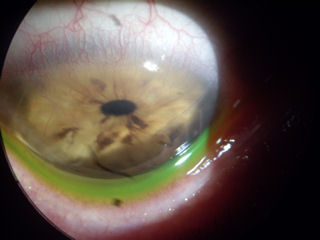 post RK, post LASIK, neovascularization