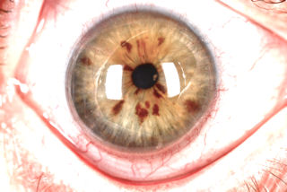 post RK, post LASIK, neovascularization