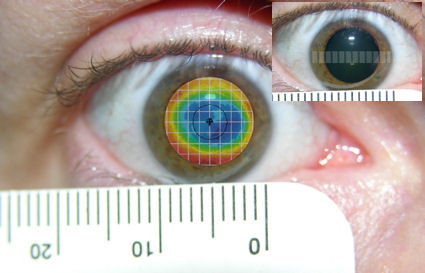 LASIK: large pupil, blend zone