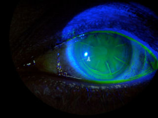 post-RK-post-LASIK-interface-staining