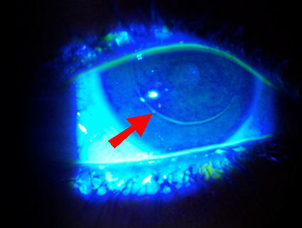 LASIK flap interface staining