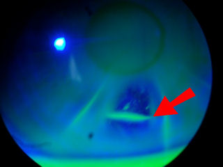 18 yr post-RK open cuts and ectasia