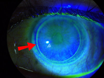 staining at LASIK flap edge