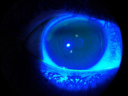 irregular LASIK flap