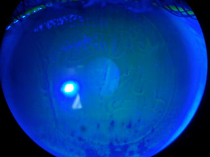 post-lasik map-dot-fingerprint corneal dystrophy