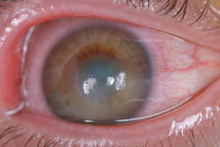 post-lasik ectasia with hydrops