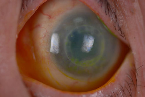 rejected corneal transplant