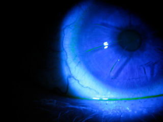 RK incisions still open after 20 years