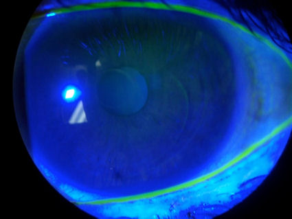 cornea with two LASIK flaps