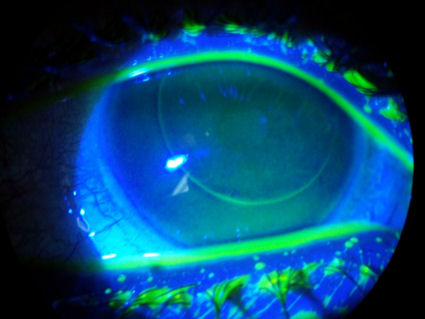 5 year post-LASIK cornea with open flap margin