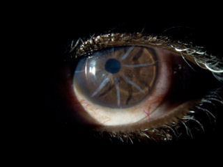 long deep wide RK scars