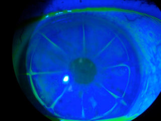 2 RK surgeries followed by 2 LASIK surgeries