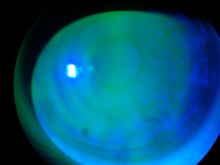 tear film post-blink