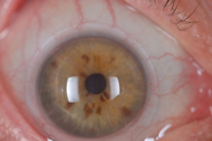 RK LASIK ectasia neovacularization