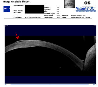 post RK bullous keratopathy OCT scan 
