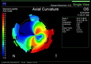 topography of post-LASIK ectasia irregular astigmatism