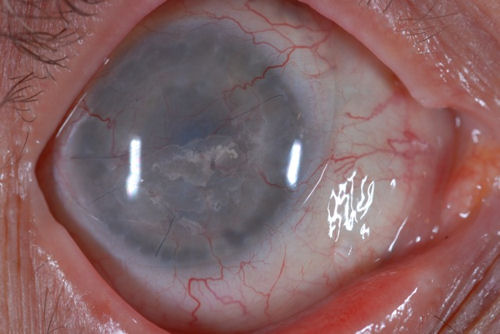 rejected corneal transplant
