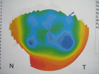 two RK procedures and two LASIK procedures