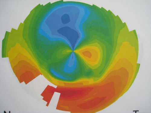 topography of corneal transplant