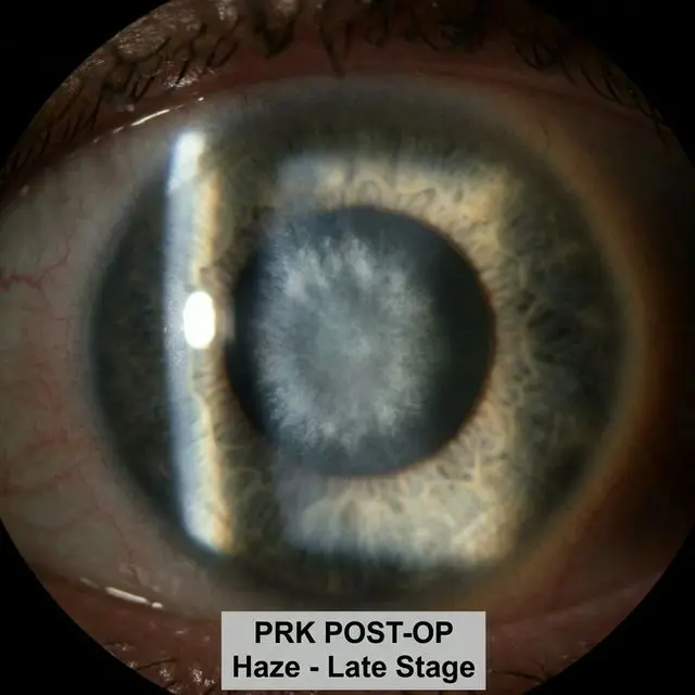 Поздний хейз роговицы (помутнение) после ФРК на щелевой лампе. Диффузное белое пятно в центре.