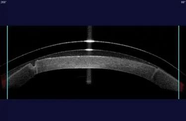 Файл из архива RKSurvivors: sclerallens-rkcornea_med.jpeg