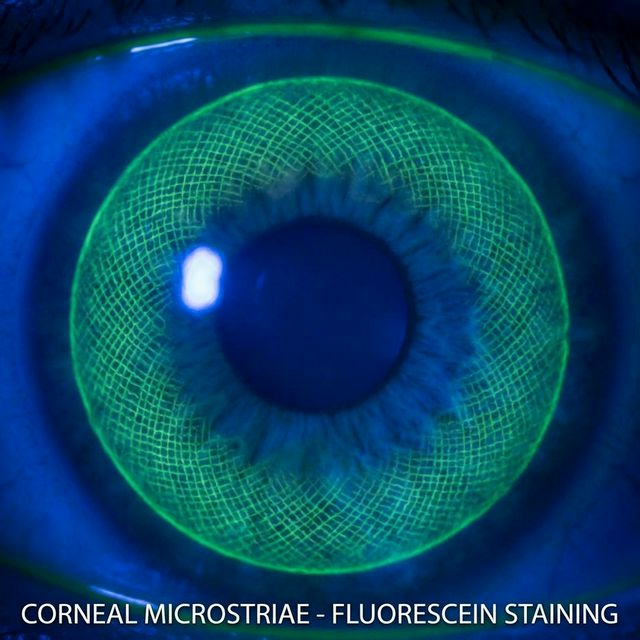 Микрострии в виде тонкой сетки или &ldquo;паутины&rdquo; при осмотре на щелевой лампе.