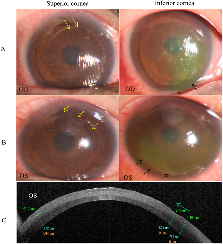 Двусторонняя дислокация лоскута через 20 лет после LASIK: оба глаза, стрелками отмечены зоны отслойки лоскута; внизу — OCT